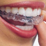 Invisalign