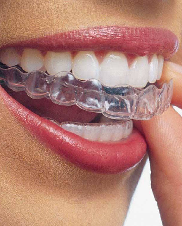 Invisalign